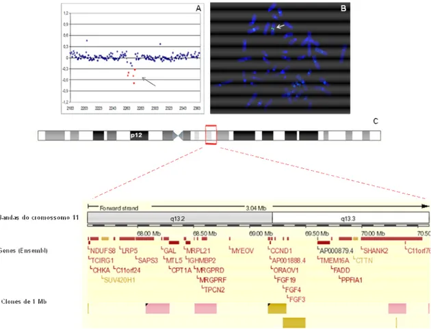 Figura 9 – Deleção em 11q13.2q13.4 no Paciente 6. (A) Perfil do cromossomo 11 por  aCGH