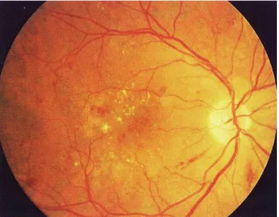 Fig. 4 : Fundo do olho com Retinopatia Diabética; [49] 