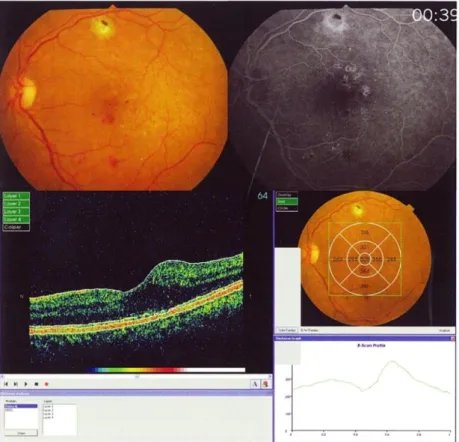 Fig. 9 : Retinografia, Imagem angiográfica e OCT de um olho direito com retinopatia   não proliferativa; [49] 