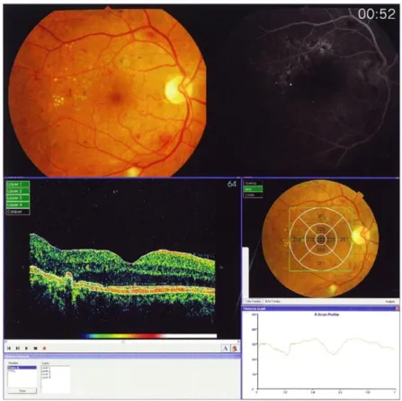 Fig. 10 : Retinografia, Imagem angiográfica e OCT de um olho direito com retinopatia pré- pré-proliferativa;[49] 