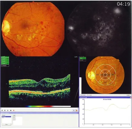 Fig. 11 : Retinografia, Imagem angiográfica e OCT de um olho direito com retinopatia proliferativa;[49]  