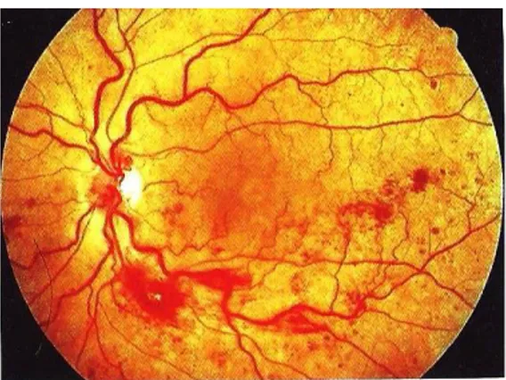 Fig.  25:  Oclusão  dos  dois  ramos  inferiores  da  veia  central  da  retina:  a  hemorragia  ocorre  apenas  nas  áreas afetadas