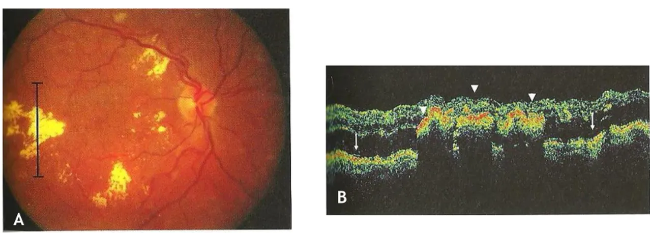 Fig. 28: Maculopatia diabética. (A) Edema macular diabético grave com exsudados duros (amarelo)