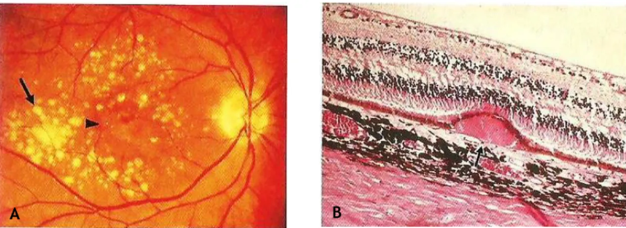 Fig. 31: DMRI não exsudativa. (A) Sinais típicos incluem drusas (setas) e atrofia geográfica central (ponta  de seta)