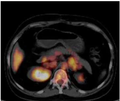 Figura 4  – PET/CT de paciente com PMAH: adrenais com dimensões aumentadas, apresentando  múltiplos  nódulos,  com  captação  de  18 F-FDG  de  padrão  discretamente  heterogêneo  e  grau  discreto, com maior grau de concentração relativa à esquerda (SUVmá