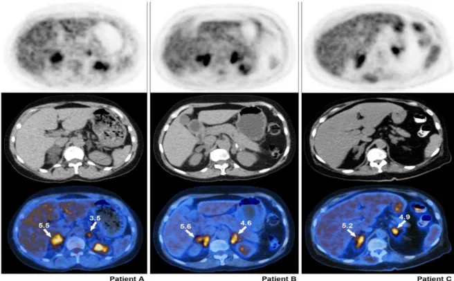 Figura  7  -  Imagem  transaxial  de  18 F-FDG-PET/CT  em  três  pacientes  com  PMAH,  demonstrando massas adrenais bilaterais com captação aumentada de  18 F-FDG em comparação  com  o  fígado
