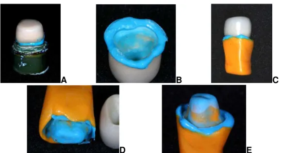 Figura 4.5. A. Assentamento da coroa cerâmica sobre o dente preparado após a introdução, na parte  interna da coroa, do material de moldagem leve; B