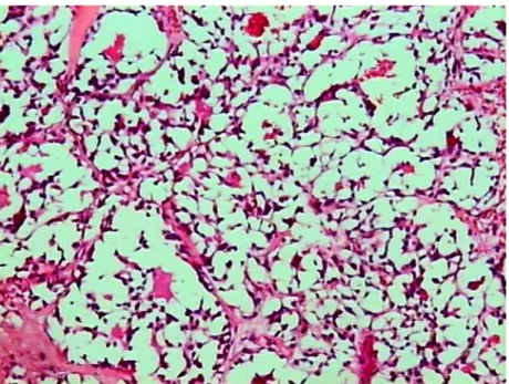 Figura 4-  Caso 17. Corte histológico de linfonodo com metástase de carcinoma  medular sólido de pequenas células