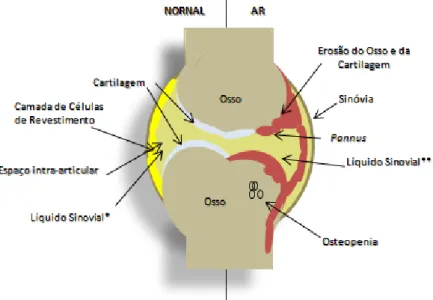 Figura 1.8 - Representação esquemática de uma articulação normal e artrítica. 