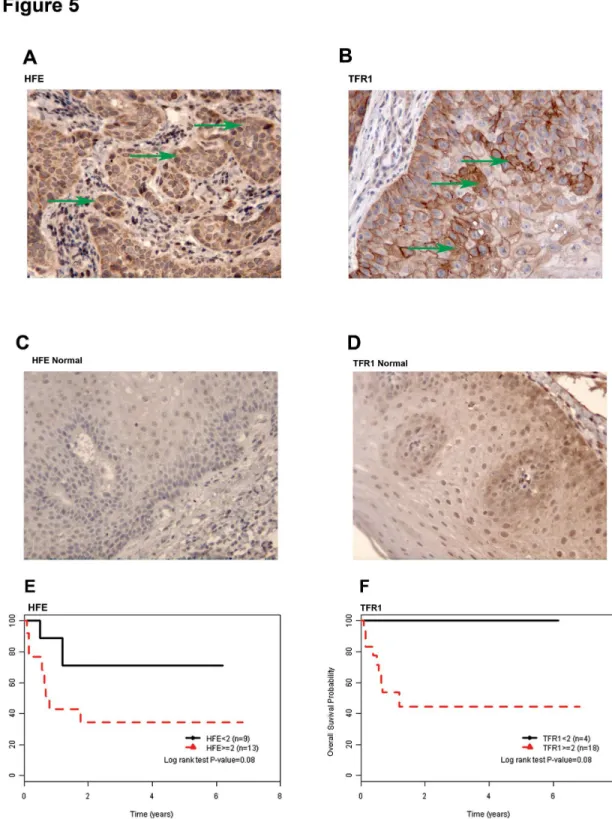 Figure 5.    HFE and TFR1 expression in HNSCC patient samples.    (A)  A  representative  image  of  HFE  immunohistochemical expression from a primary HNSCC biopsy; arrows indicating tumor cells exhibiting cytoplasmic signal