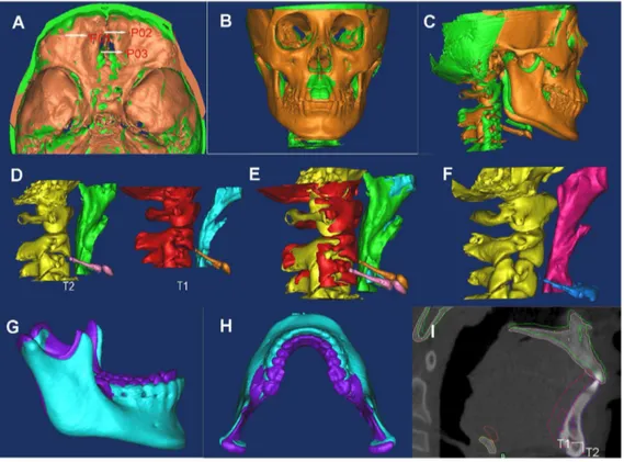 Figure 3. The pre- (T1) and post-treatment (T2) data of TB patients was registered. A) Point registration with the most protruding points on the anterior cranial base