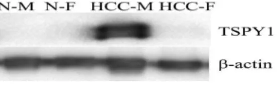 Figure 4. The result of western blot for TSPY1 protein in male and female HCC, and normal liver tissue (N-M: normal male liver tissue; N-F: normal female liver tissue; HCC-M: male HCC tissue; HCC-F: female HCC tissue).