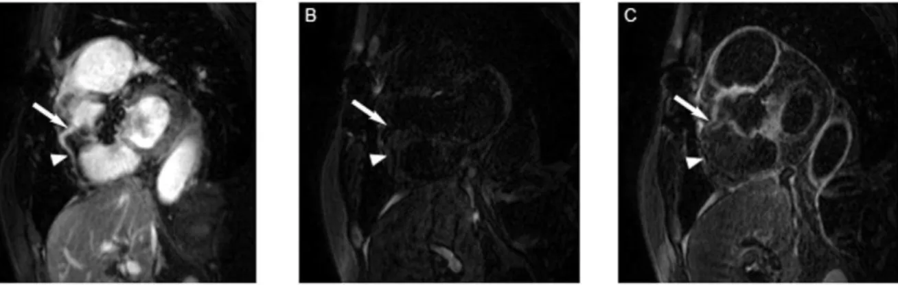 Figure 3. No significant difference of coronary CNR post contrast was seen between the patients with TA and those with CAD.