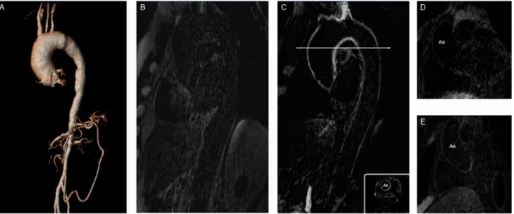 Figure 6. Both groups showed a significant increase of CNR of the aortic wall after contrast application with p = 0.028 in each group