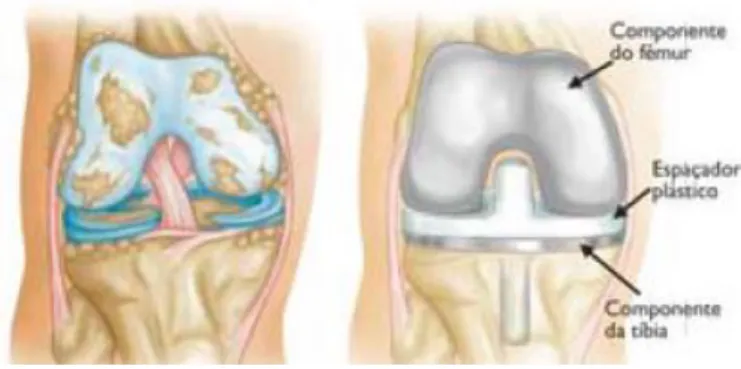 Figura  3  –  Esquerda:  Osteoartrose  grave;  Direita:  Implantes  metálicos  no  fémur  e  na  tíbia,  com  espaçador  de  polietileno  entre  os  implantes