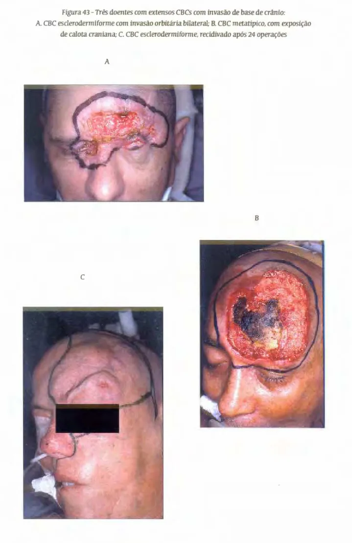 Figura 43- Tres  doentes  com  extensos  CBCs com invasao de base de  crania: 