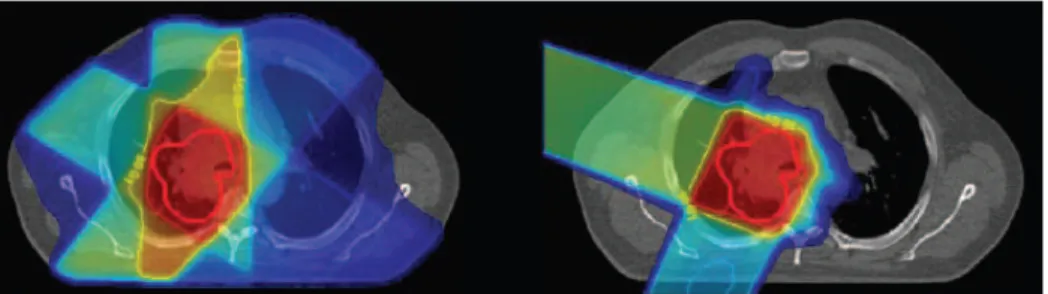 Figure 2.2: Comparison of dose color-wash display superimposed onto a grey-scale CT of photon (left) and proton (right) treatment plans