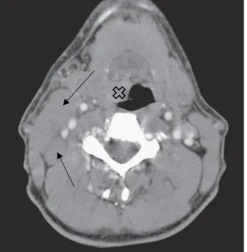 Figura 3 – Imagem axial de TC:  tumor na base direita da  língua  (cruz)  e  adenopatia  metastática  cervical  (setas)  (retirado de Smith T.J., et al., 2017)  