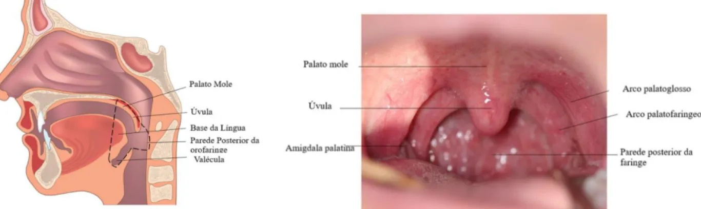 Figura 1 - Ilustração (A) e fotografia (B) dos limites anatómicos e aspeto clínico da orofaringe (retirado de  A: depositphotos.com e B: Yakin M et al., 2018 