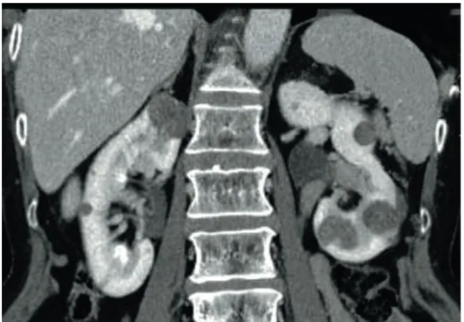 Figura 2 – Carcinoma papilar renal multifocal em imagem de TC.  
