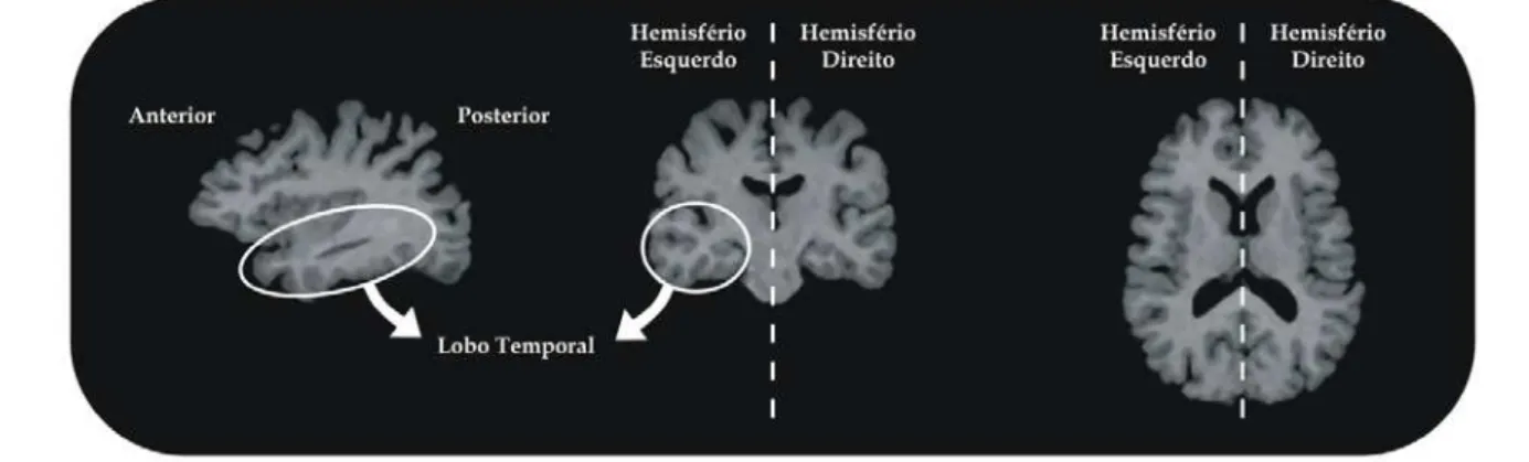 Figura 4 – Divisão básica cerebral. A figura mostra três cortes: sagital, axial e coronal,  respectivamente