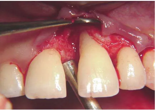 Figura 4.5- Afastamento do retalho para preparo radicular e do defeito. Após este momento a  superfície  