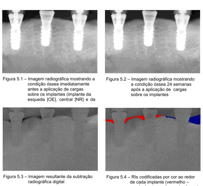 Figura 5.1  –  Imagem radiográfica mostrando a                        condição óssea imediatamente                       antes a aplicação de cargas                       sobre os implantes (implante da                       esqueda  [OE],  central  [NR]  