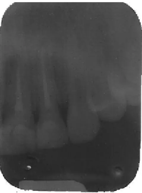 Figura 4.4– Radiografia convencional obtida do dente com tratamento endodôntico. 