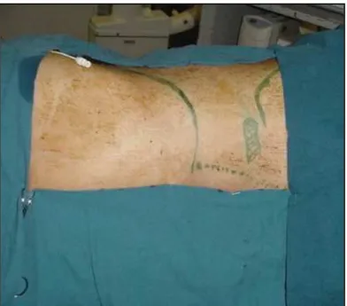 Figura 3 -  Paciente em DDH com coxim para elevação dos flancos, com marcação  cirúrgica de rebordo costal e crista ilíaca e cateter ureteral para  contrastação da via excretora 