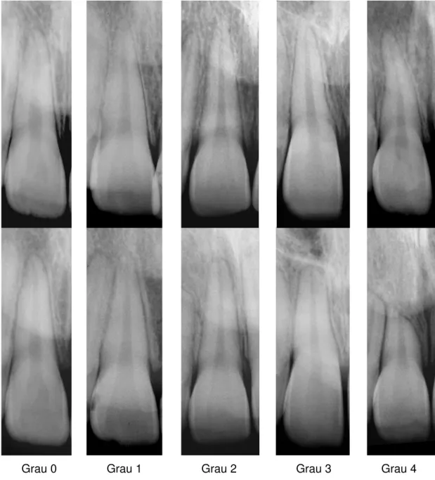 FIGURA 4.2 – Classificação do grau de reabsorção nos incisivos superiores,  realizada nas radiografias pré e pós-tratamento