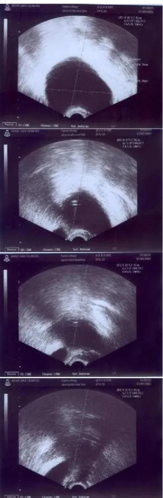 Figura 4 -  Punção de cisto do ovário 