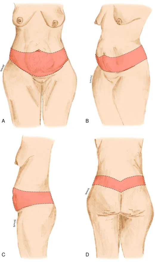 Figura 2. Demarcação da abdominoplastia circunferencial simples (ACS)  