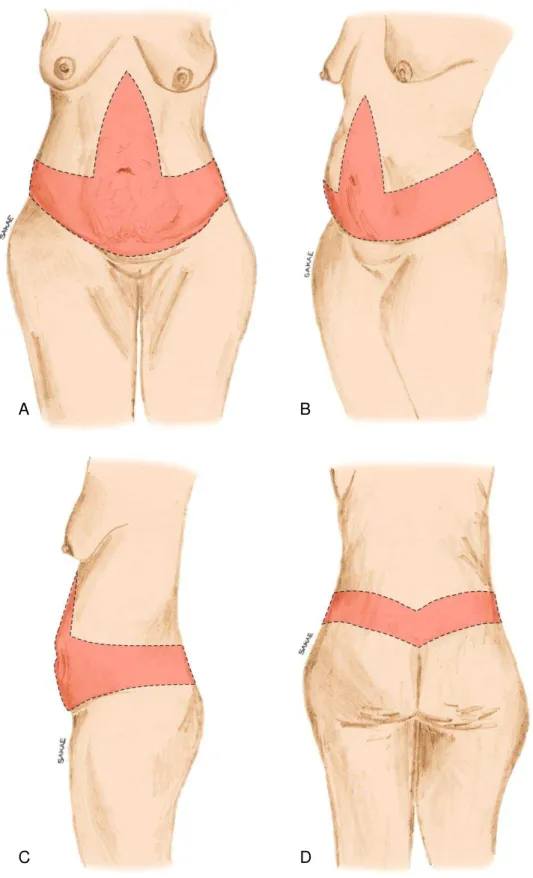 Figura 3. Demarcação da abdominoplastia circunferencial composta (ACC)  