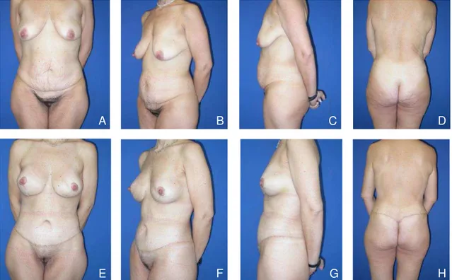 Figura 4. Abdominoplastia circunferencial simples (ACS)  