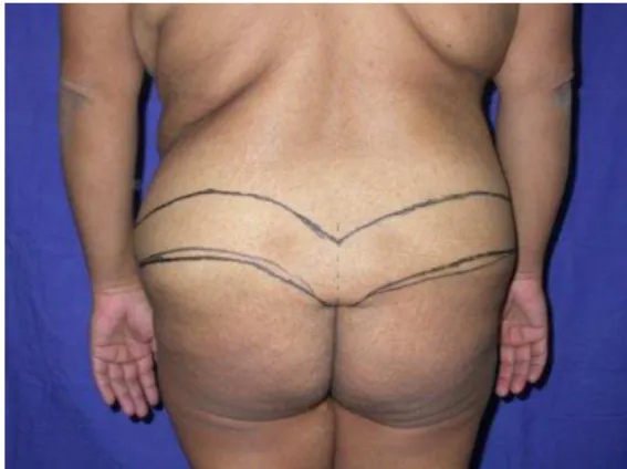 Figura 7. Posicionamento inferior da área de ressecção posterior da abdominoplastia  circunferencial 