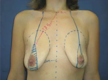 Figura 4. Demarcação pré-operatória da área correspondente à loja a ser  dissecada para a inclusão dos implantes mamários