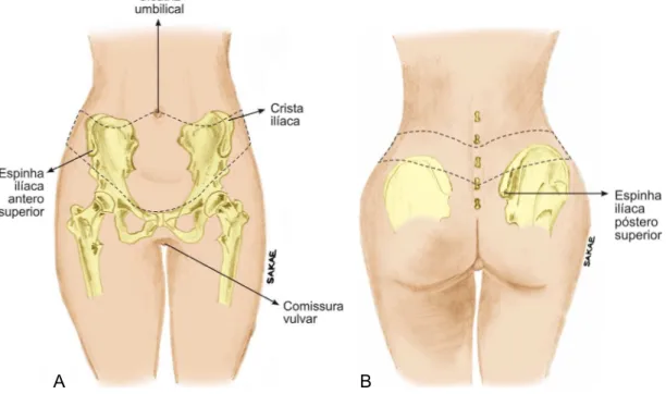 Figura 3. Parâmetros anatômicos na demarcação da abdominoplastia circunferencial. 