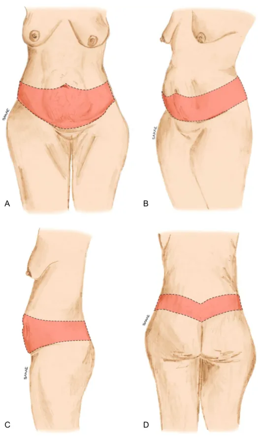 Figura 4. Demarcação da abdominoplastia circunferencial simples (ACS).  