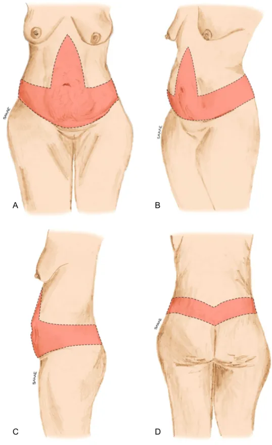 Figura 5. Demarcação da abdominoplastia circunferencial composta (ACC).  