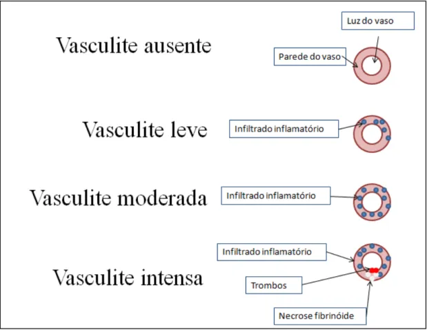 Figura  6  -  diagrama  esquemático  mostrando  a  classificação  das  vasculites  quanto à sua intensidade 
