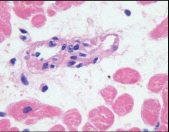 Figura 7 - microfotografia mostrando pequena artéria com infiltrado linfocitário  em suas paredes caracterizando vasculite leve, coloração hematoxilina eosina,  aumento 200x 