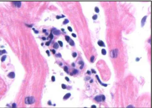 Figura 8-microfotografia mostrando infiltrado inflamatório acometendo parte da  parede de pequena artéria intramiocardica, coloração hematoxilina eosina,  aumento 200x 