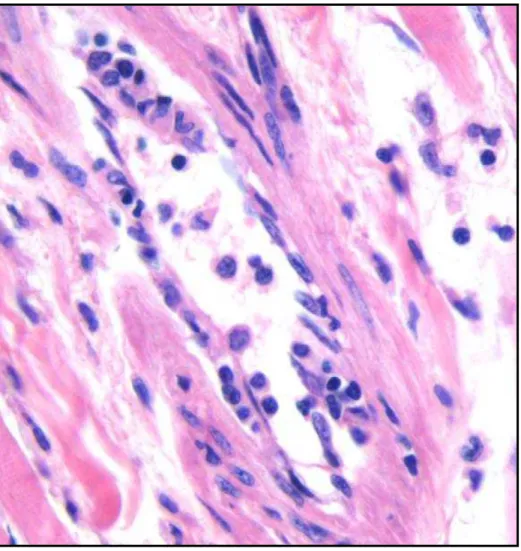 Figura 9 microfotografia mostrando infiltrado inflamatório acometendo parte da  parede de uma vênula caracterizando vasculite leve, coloração hematoxilina  eosina aumento 200x 