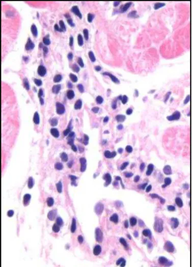 Figura 11- microfotografia mostrando vênula intramiocardica com todas as  paredes do vaso infiltrado por linfócitos sendo caracterizado como  vasculite  moderada , coloração hematoxilina eosina, aumento 200x 