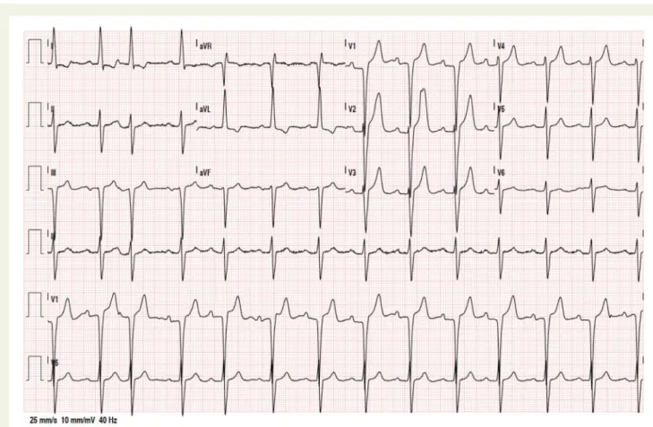 Figure 1 Patient’s electrocardiogram on admission: sinus rhythm with left axis deviation and repolarization abnormalities.