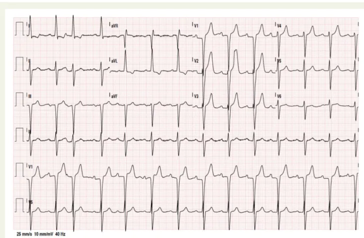 Figure 1 Patient’s electrocardiogram on admission: sinus rhythm with left axis deviation and repolarization abnormalities.