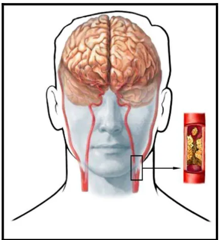 Figura 5. Desprendimento de êmbolo proveniente de placa aterosclerótica  carotídea 