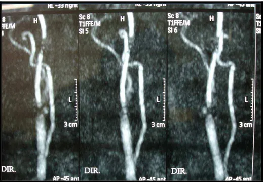 Figura 14. Angiografia por ressonância magnética demonstra estenose  grave do bulbo carotídeo direito 