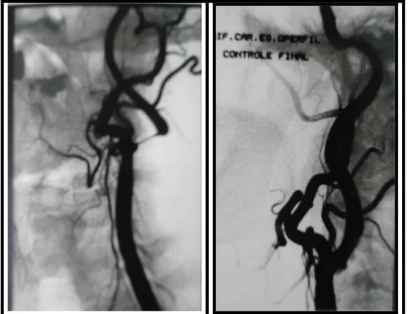 Figura 20. Estenose grave do bulbo carotídeo à DSA (A). Controle  angiográfico demonstra boa abertura do stent sem estenose residual