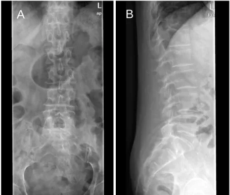 Figura 5 – Radiografia da coluna lombar com incidência (A) ântero-posterior e de (B) perfil, realizada  ao 18º APD